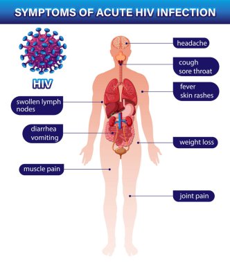Akut HIV enfeksiyonu illüstrasyon belirtileri
