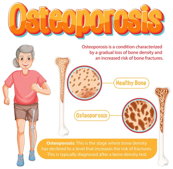 Информационный Плакат Иллюстрации Остеопороза Костей Человека — стоковый вектор