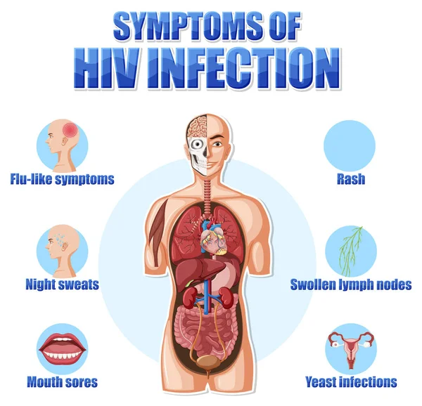 Cartaz Informativo Dos Principais Sintomas Ilustração Hiv — Vetor de Stock