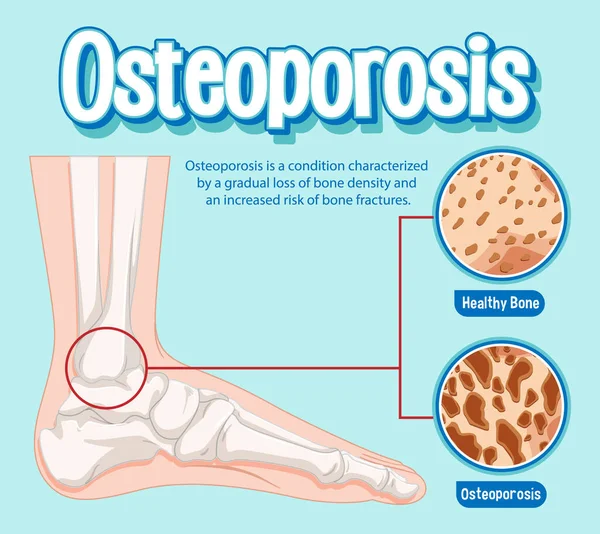 Informative Poster Osteoporosis Human Bone Illustration — Stock Vector