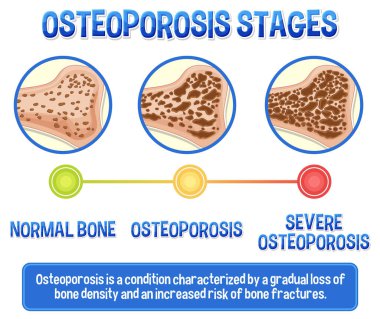 Osteoporoz insan kemik çiziminin bilgilendirici posteri