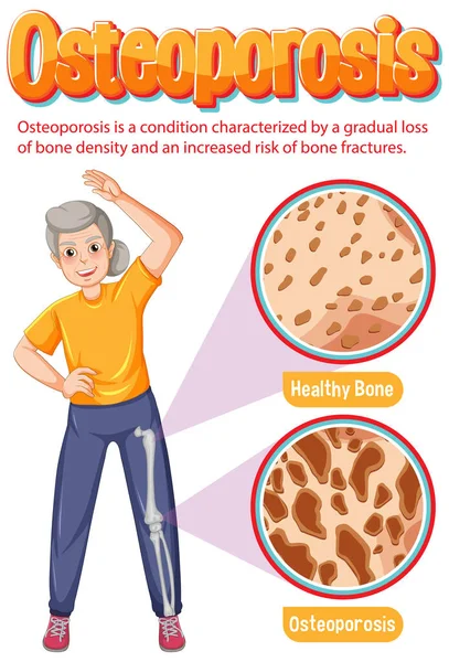 Srovnání Normální Kostní Kostní Tkáně Osteoporózou Starších Pacientů Ilustrace — Stockový vektor