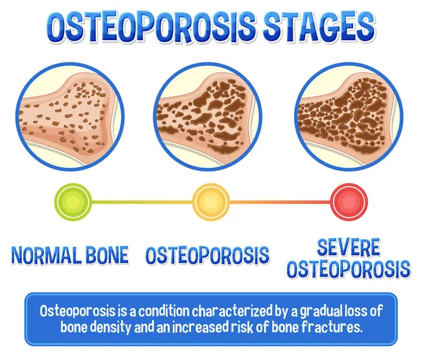 Informativ Affisch Osteoporos Människoben Illustration — Stock vektor