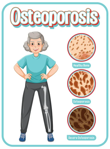 Srovnání Normální Kostní Kostní Tkáně Osteoporózou Starších Pacientů Ilustrace — Stockový vektor