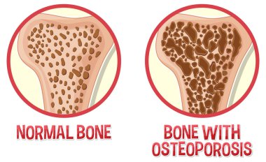 Osteoporoz illüstrasyonuyla normal kemik ve kemik karşılaştırması