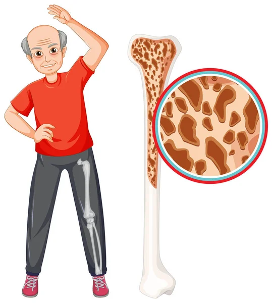 Osteoporosis Ancianos Ilustración — Archivo Imágenes Vectoriales