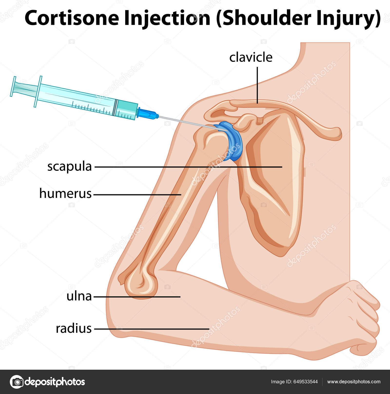 Cortisone Injection Shoulder Injury Diagram Illustration Stock Vector by ©interactimages 649533544
