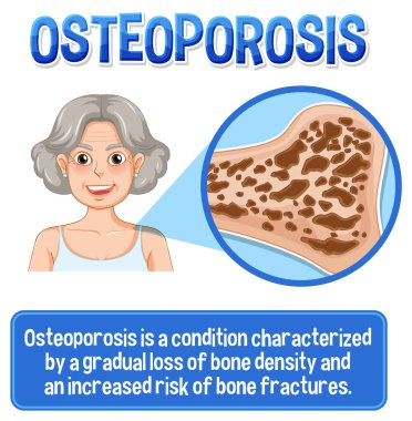 Osteoporoz insan kemik çiziminin bilgilendirici posteri