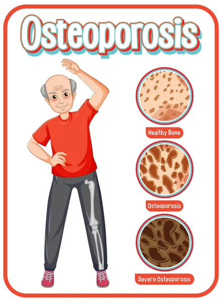 Perbandingan Tulang Dan Tulang Normal Dengan Osteoporosis Pada Ilustrasi Orang - Stok Vektor