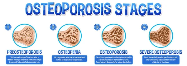 Cartel Informativo Osteoporosis Ilustración Ósea Humana — Archivo Imágenes Vectoriales
