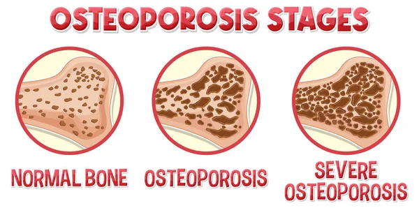 Cartel Informativo Osteoporosis Ilustración Ósea Humana — Vector de stock