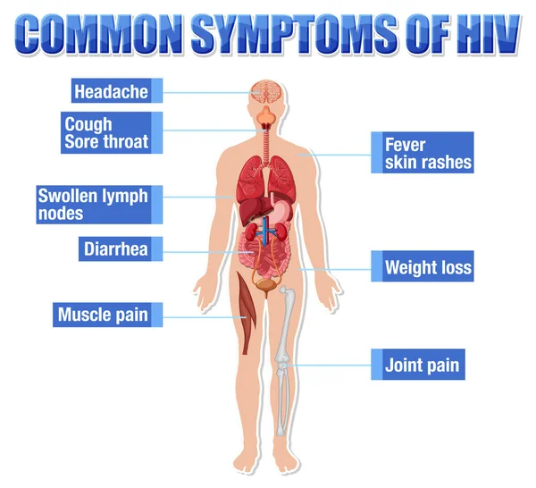 Hiv Illüstrasyonunun Yaygın Belirtilerinin Bilgilendirici Posteri — Stok Vektör