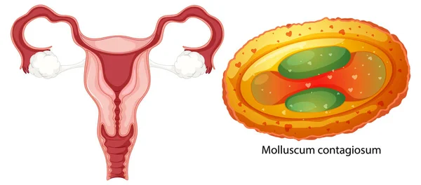 Vaginale Infectie Bacteriën Concept Illustratie — Stockvector