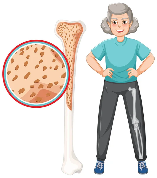 Osteoporosis Ancianos Ilustración — Archivo Imágenes Vectoriales