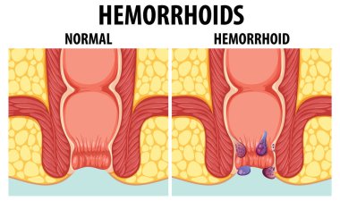 Normal ve iç hemoroidler arasındaki farklılıkları gösteren eğitici grafikler