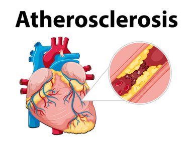 Kalp anatomisi ve ateroskleroz gelişimi hakkında resimli bilgi