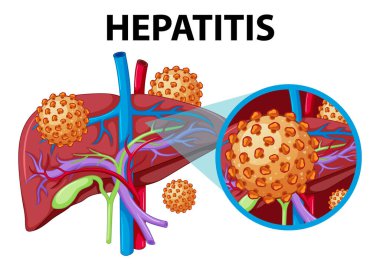 İnsan karaciğerinin bilimsel ve tıbbi eğitimini hepatitle betimleyen bir resim.