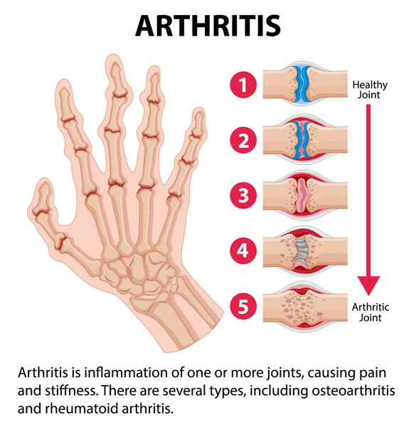 Illustrated infographic depicting stages of arthritis in the human hand