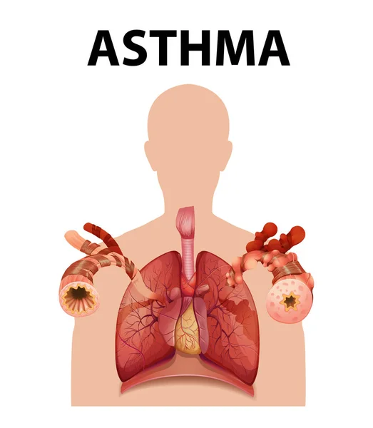 Illustration Comparant Les Poumons Humains Dans Des Conditions Normales Asthme — Image vectorielle