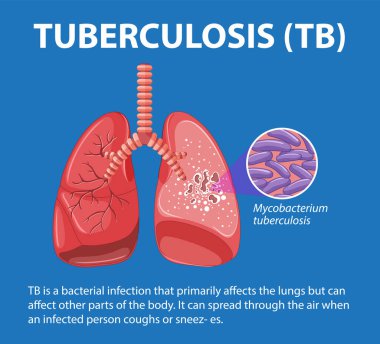 Illustrated infographic depicting the medical education of human lung anatomy with tuberculosis clipart