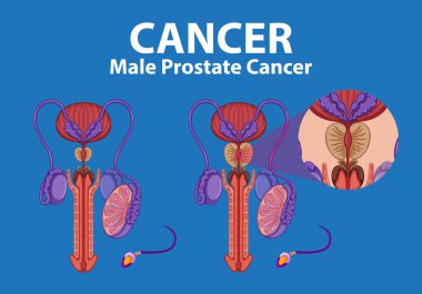 Sağlıklı ve kanserli prostat arasındaki farklılıkları vurgulayan resimli bilgiler