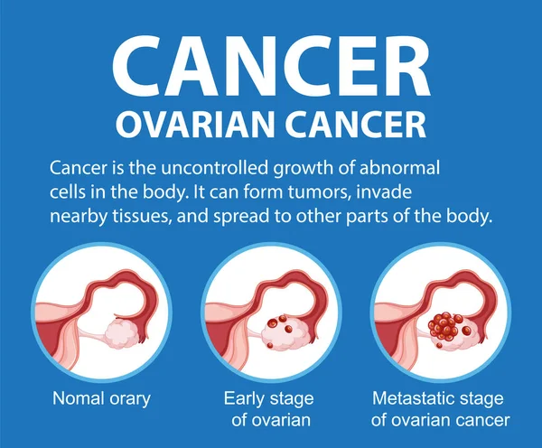 Illustrated Infographic Depicting Stages Ovarian Cancer Women — Stock Vector