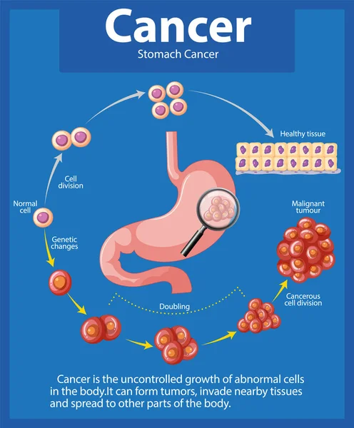 Εικονογραφημένο Infographic Που Απεικονίζει Ανώμαλη Κυτταρική Ανάπτυξη Στον Καρκίνο Του Royalty Free Διανύσματα Αρχείου