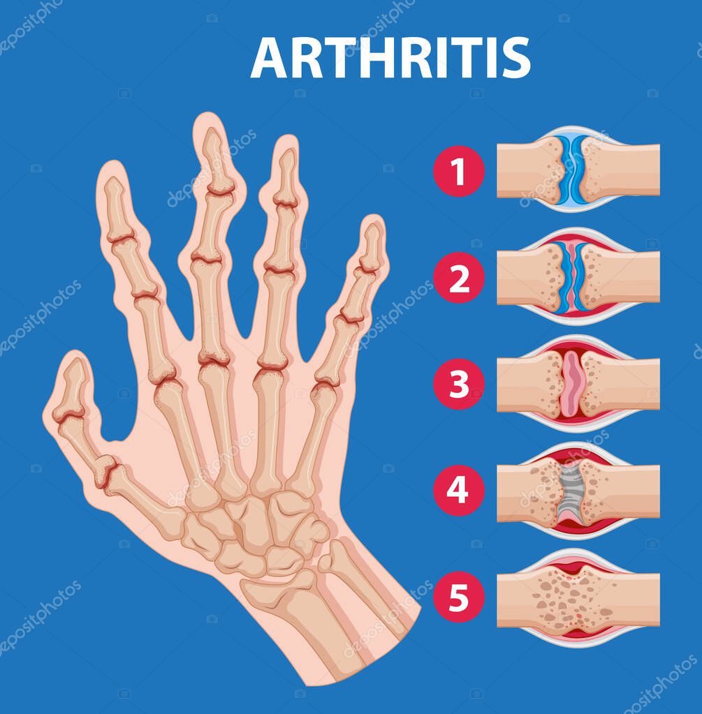 Etapas ilustradas de la artritis en una mano humana 2024