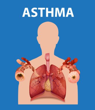 Tıp eğitimi bağlamında normal ve astım akciğerlerini karşılaştıran bilgilendirici bir bilgi