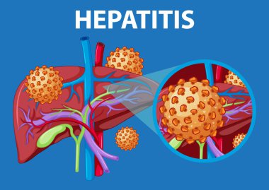 Hepatitten etkilenmiş bir karaciğerin anatomisini tasvir eden bir resim