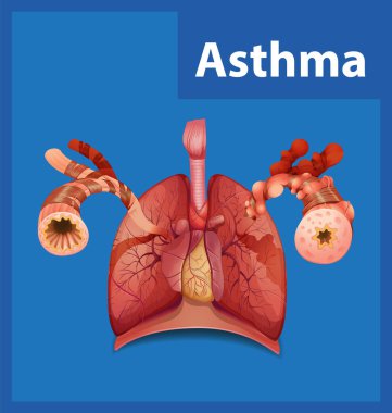 Tıp eğitimindeki normal ve astım akciğerlerini karşılaştıran resimli bilgi