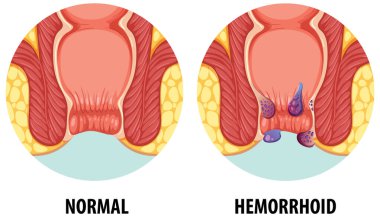 Normal anatomiyi hemoroit durumuyla karşılaştırma.