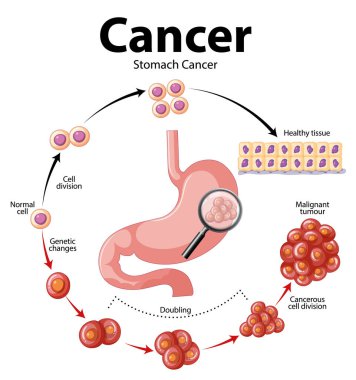 Mide kanserindeki anormal hücre büyümesini gösteren resimli bilgi