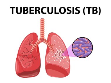 İnsan akciğer anatomisinin tıbbi eğitimini tüberkülozla gösteren resimli bilgi