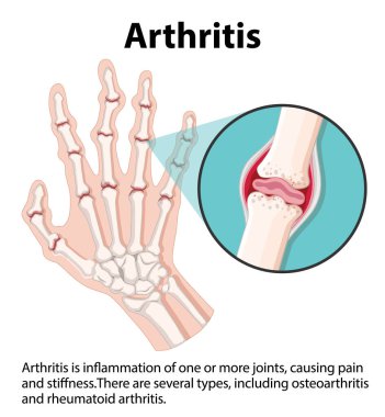 İnsan anatomisi ve artrit aşamalarını bilgilendirici bir bilgiyle öğrenin