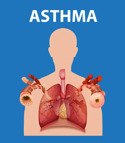 Une Infographie Informative Comparant Poumons Normaux Asthme Dans Contexte Éducation — Image vectorielle