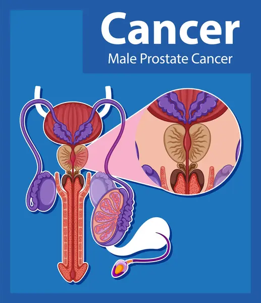 Erkek prostat kanserinde anormal hücre büyümesi olduğunu gösteren bilgiler