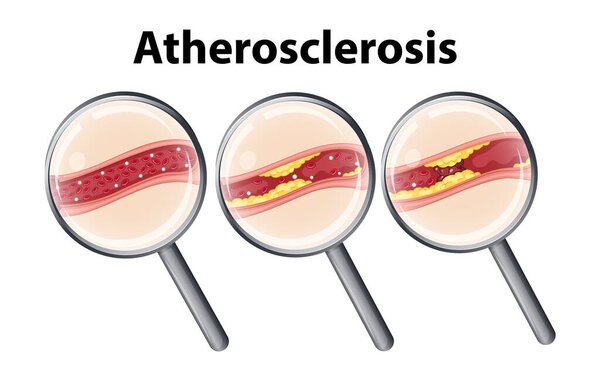 Инфографика рисков для здоровья сердца и сердечно-сосудистых заболеваний