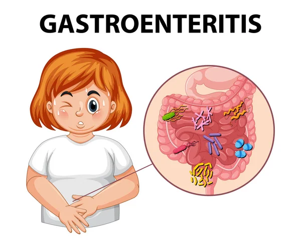 Illustration Woman Suffering Gastroenteritis Due Infection Inflammation — Stock Vector