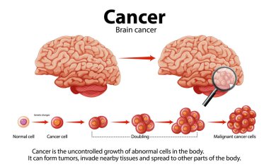 Illustration depicting brain cancer and abnormal cell growth clipart