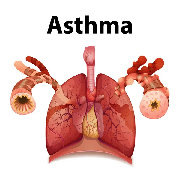 Eine Informative Infografik Die Normale Und Asthma Lungen Kontext Medizinischer — Stockvektor