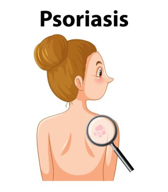 Sedef hastası bir insanı, bir deri hastalığını tasvir eden bir vektör çizimi.