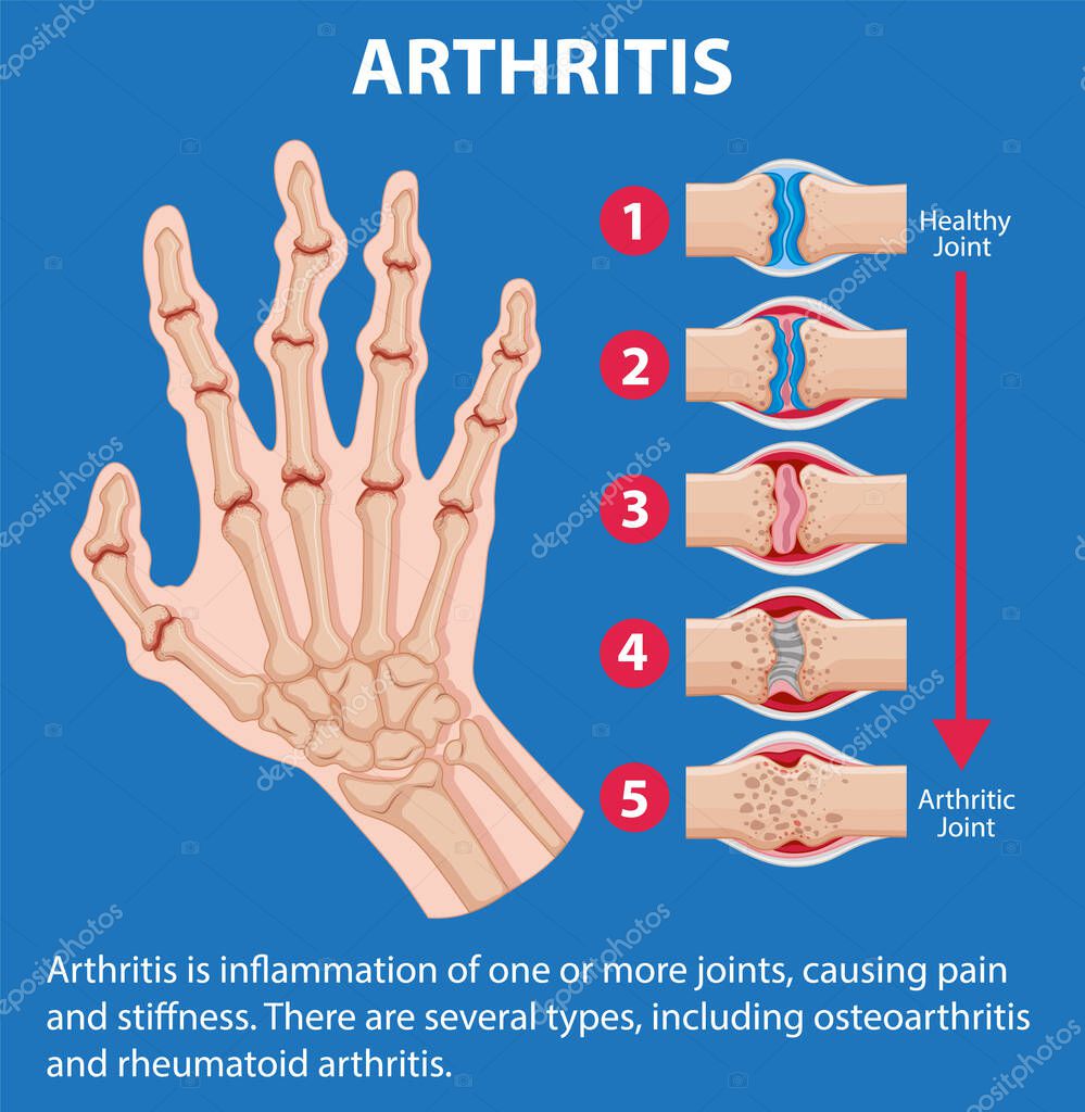 Infografía Que Representa Las Etapas De La Artritis En La Mano Humana 2024