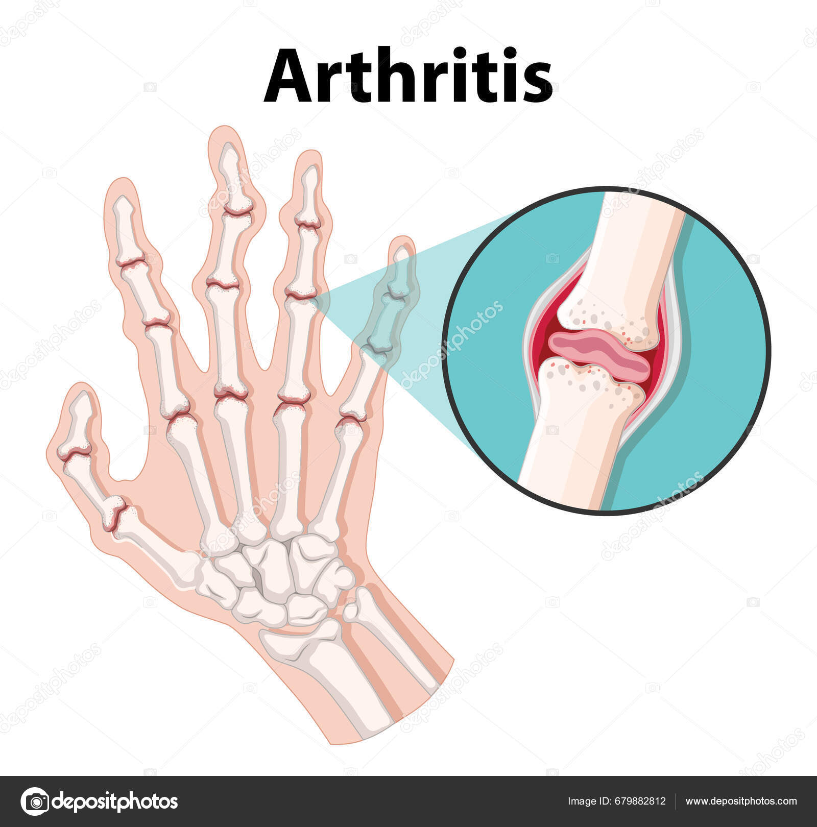 Learn Human Anatomy Arthritis Stages Science Education Infographic