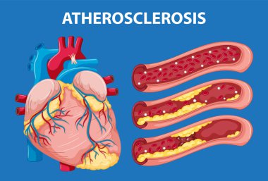 Cartoon-style illustration explaining heart anatomy and atherosclerosis development clipart