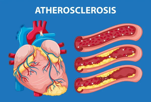 stock vector Cartoon-style illustration explaining heart anatomy and atherosclerosis development