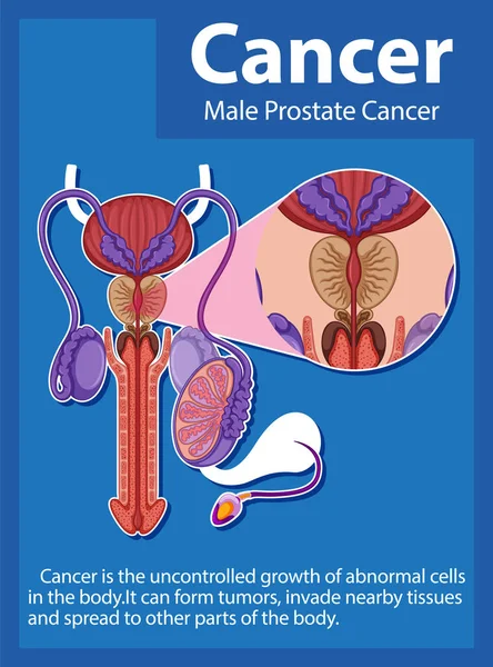 Normal ve kanserli prostat hücreleri arasındaki farkları gösteren bilgiler