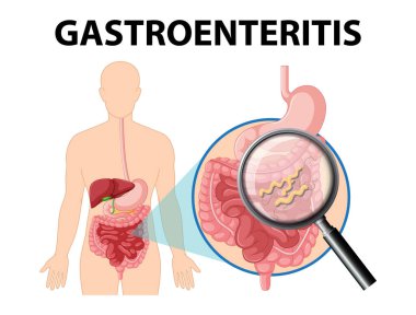 Gastroenteriti, nedenlerini ve ilişkili belirtileri tasvir eden illüstrasyon.