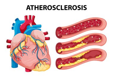Kalp anatomisini ve ateroskleroz gelişimini açıklayan çizgi film çizimleri