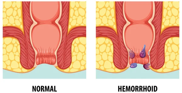 Ilustracja Porównująca Normalną Anatomię Hemoroidami Ludzi — Wektor stockowy